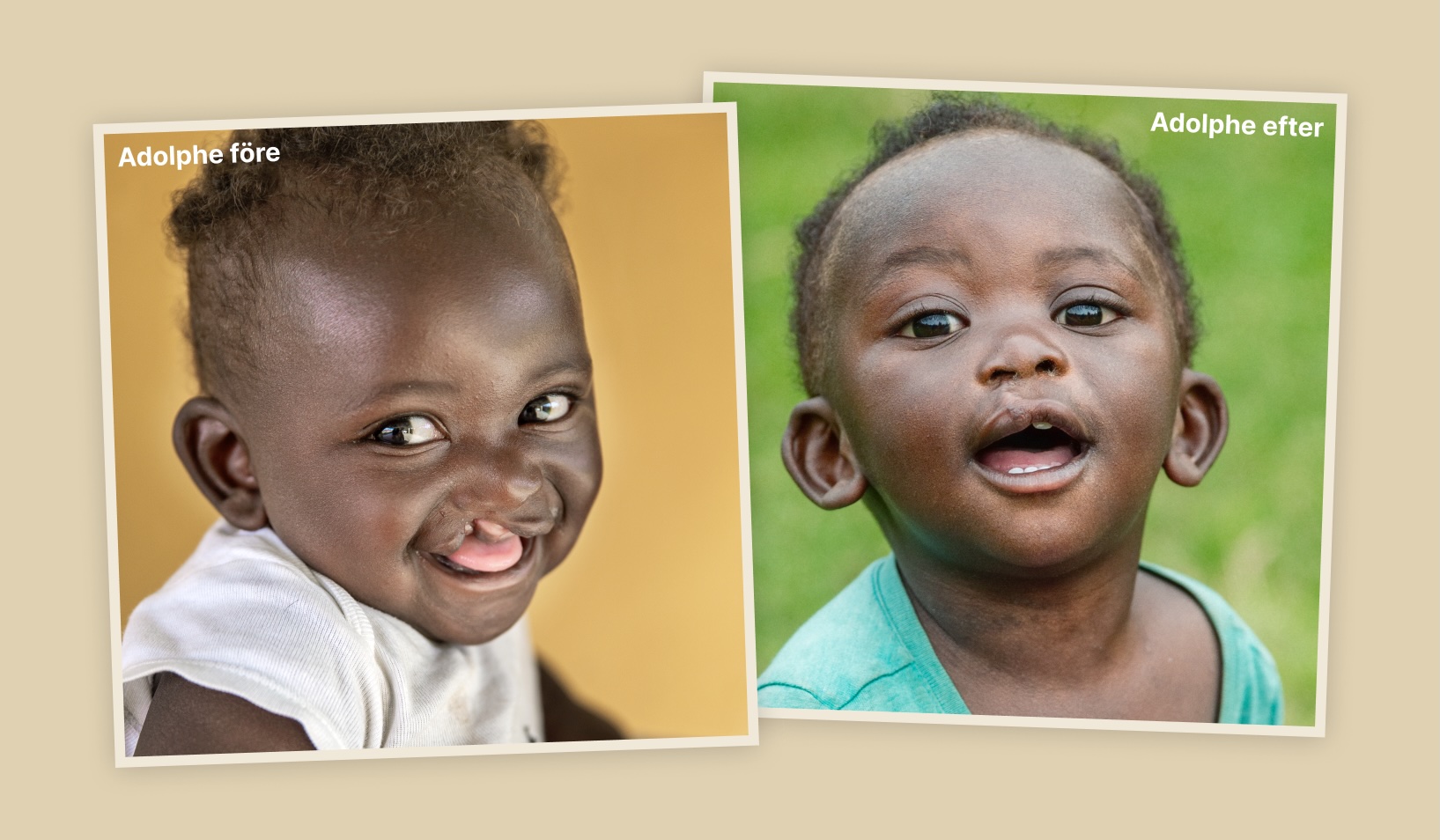 Alphonse före och efter läpp-käk-gomspalts operation.